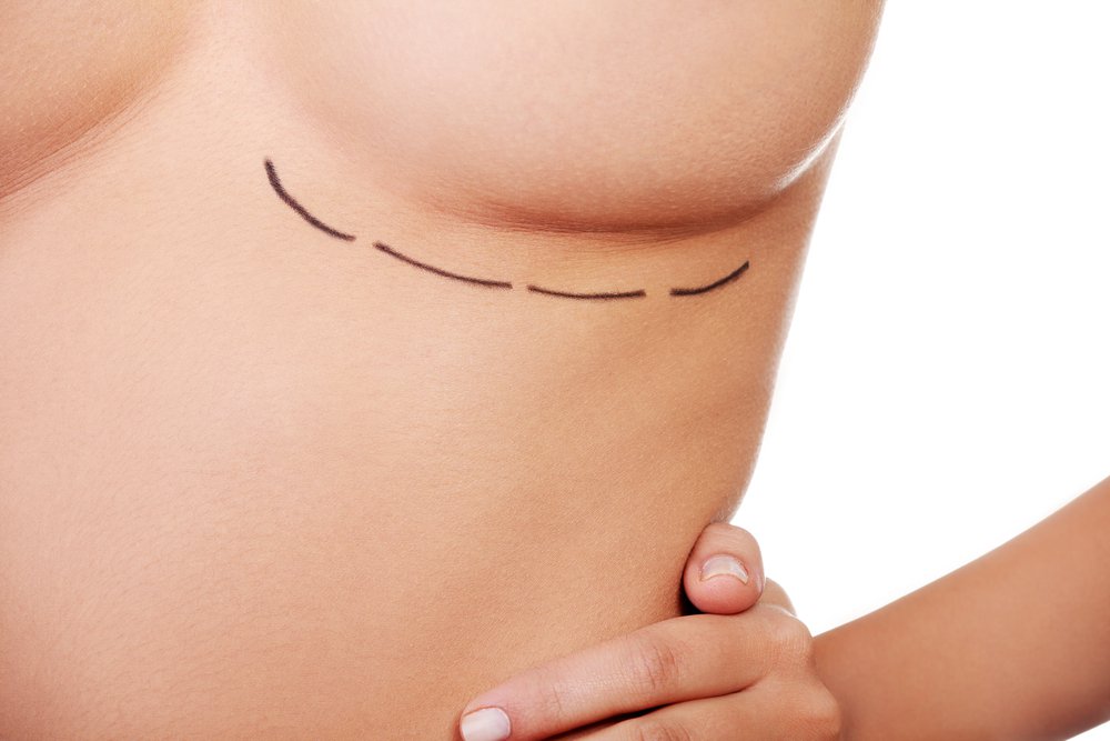 lifting-des-seins