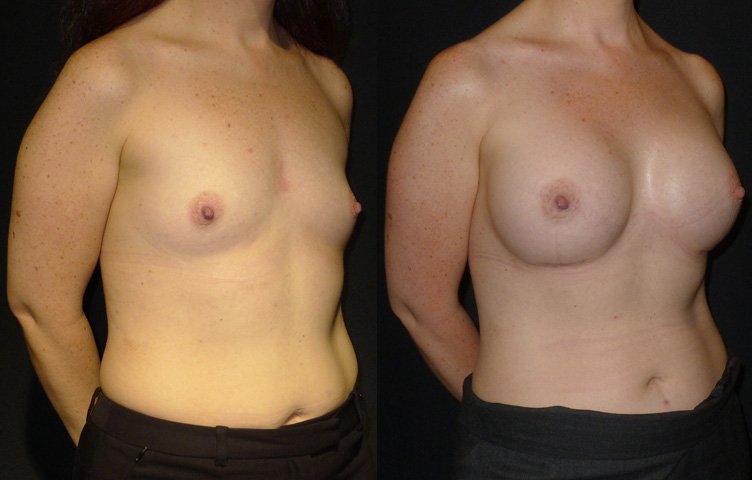 resultat-augmentation-mammaire-lipofilling