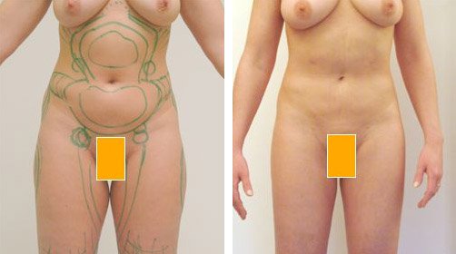 resultat-liposuccion-avant-apres