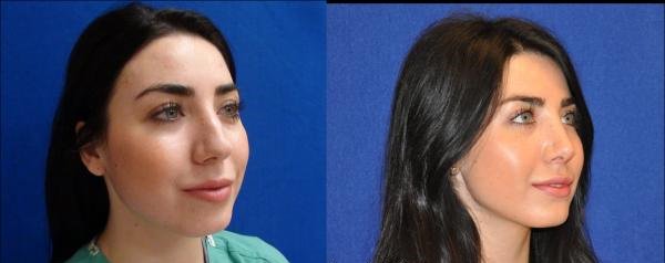 la rhinoplastie tunisie