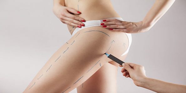 chirurgie esthétique : liposuccion Tunisie 