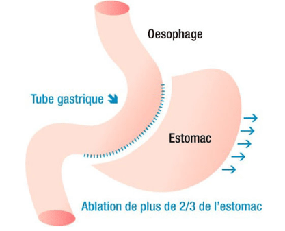 le prix d’une sleeve gastrique en Tunisie