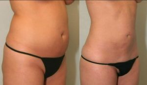 liposuccion laser