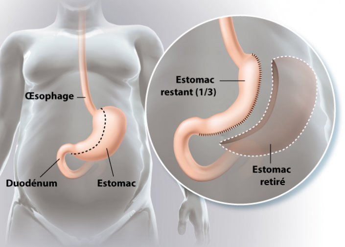 Quel est le prix d'une sleeve gastrique en Tunisie ?