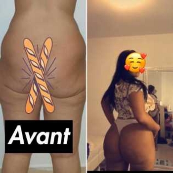 augmentation fesses avant apres